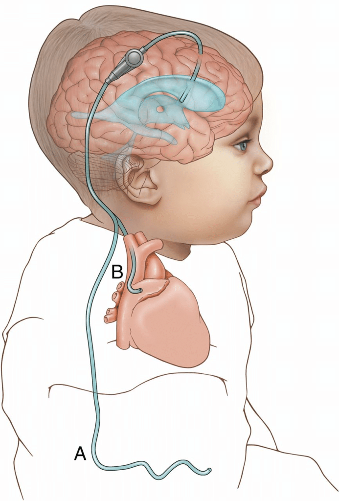 Hydrocephalus shunt - specialist implant management in hospitals